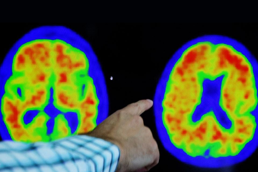 A doctor points out evidence of Alzheimer’s disease on PET scans at the Center for Alzheimer Research and Treatment (CART) at Brigham And Women’s Hospital in Boston, Massachusetts, US, March 30, 2023.