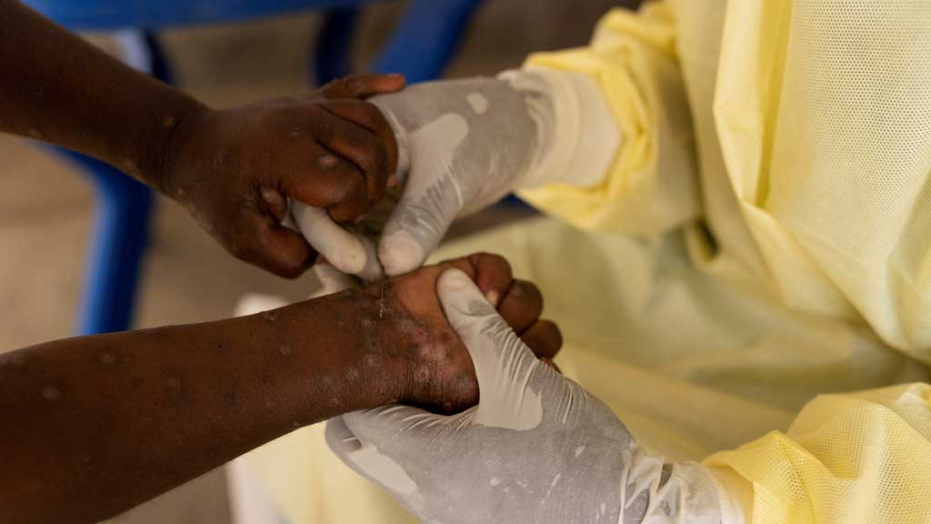 FILE PHOTO: Christian Musema, a laboratory nurse, takes a sample from a child declared a suspected case of Mpox at the treatment centre in Munigi, following Mpox cases in Nyiragongo territory near Goma, North Kivu province, Democratic Republic of the Congo Jul 19, 2024. REUTERS/Arlette Bashizi/File Photo