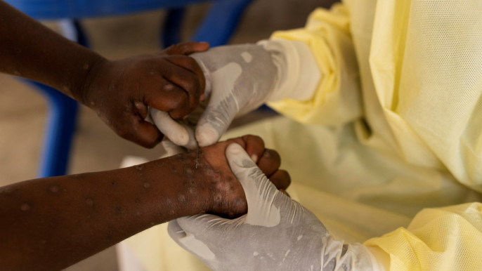 A laboratory nurse takes a sample from a child declared a suspected case of Mpox at the treatment centre in Munigi, Democratic Republic of the Congo July 19, 2024. Photo: REUTERS/Arlette Bashizi/File Photo
