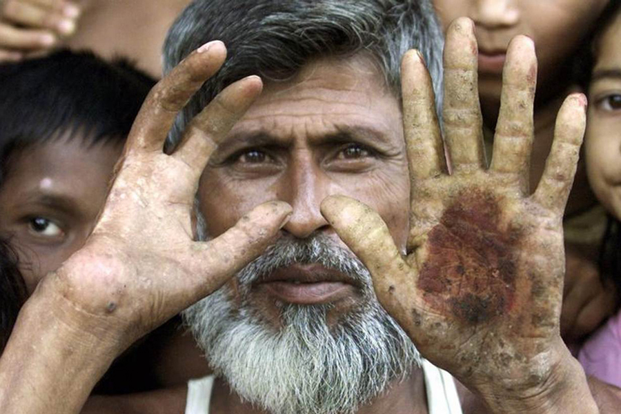 Bangladeshi villager Mohammad Ismail shows his palms affected by arsenic contamination in Sonargaon near the capital Dhaka, in this June 3, 2003 file photo. Doctors removed his two badly arsenic-affected fingers to save his right hand three years earlier.