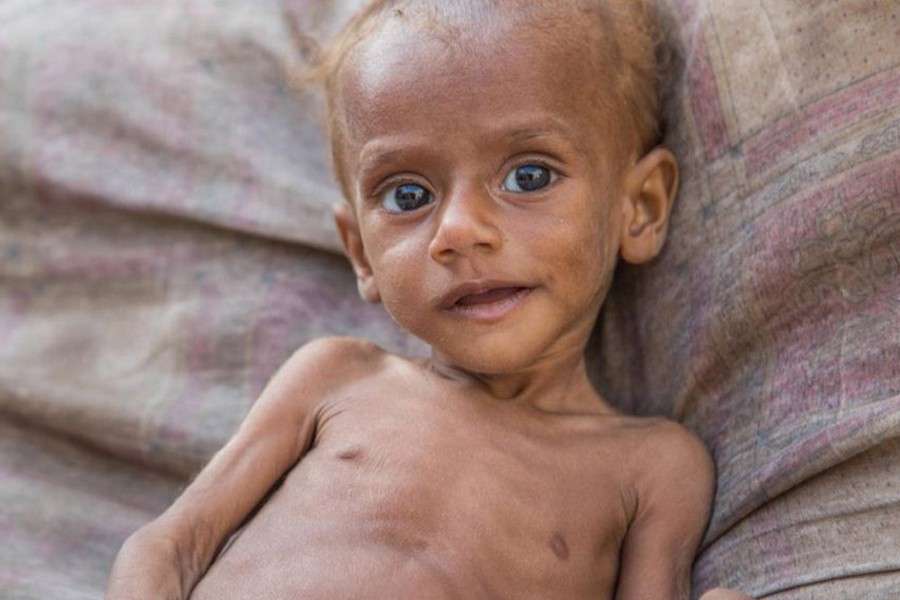 Children under the age of five are at greater risk of death from severe malnutrition. 13-month-old Nusair in Yemen. Photo: Save The Children